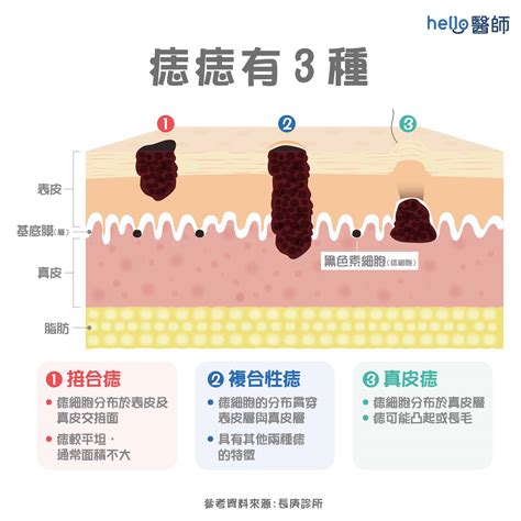 墨痣形成|「墨」同「痣」有什麼分別？他們其實是什麼東西？他們又是怎樣。